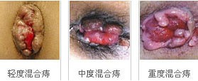 混合痔的 治疗方法