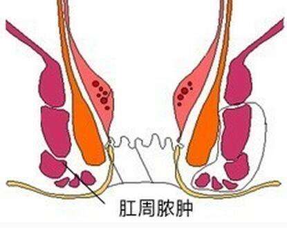 肛门脓肿如何治疗才是正确的 广州东大肛肠口碑